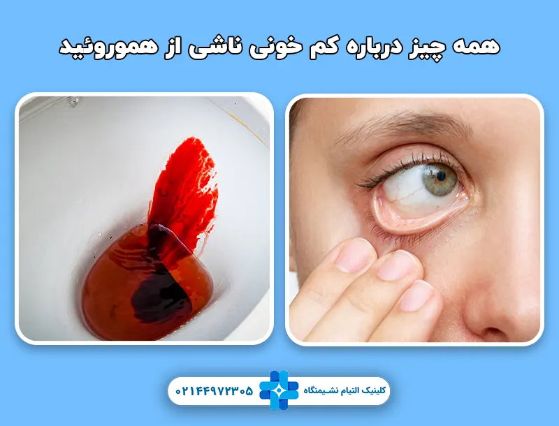 کم خونی ناشی از هموروئید