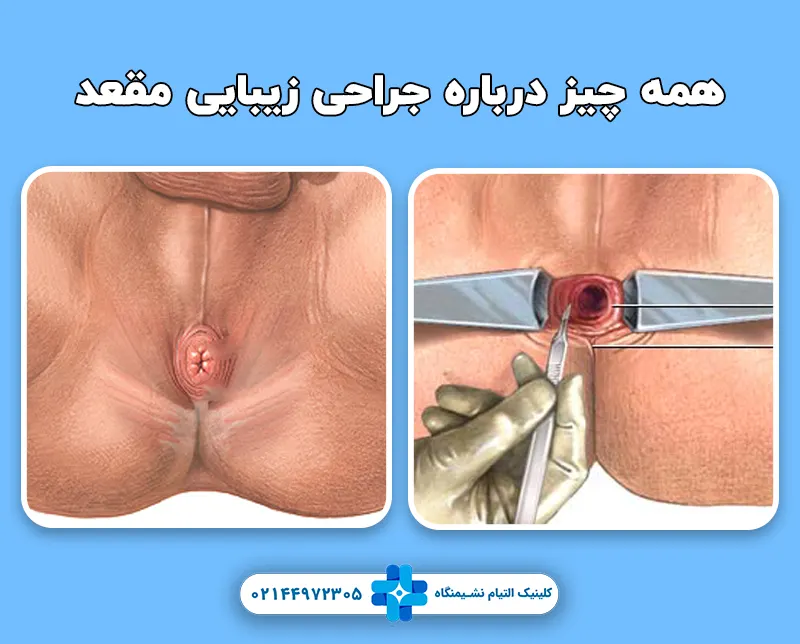 جراحی زیبایی مقعد