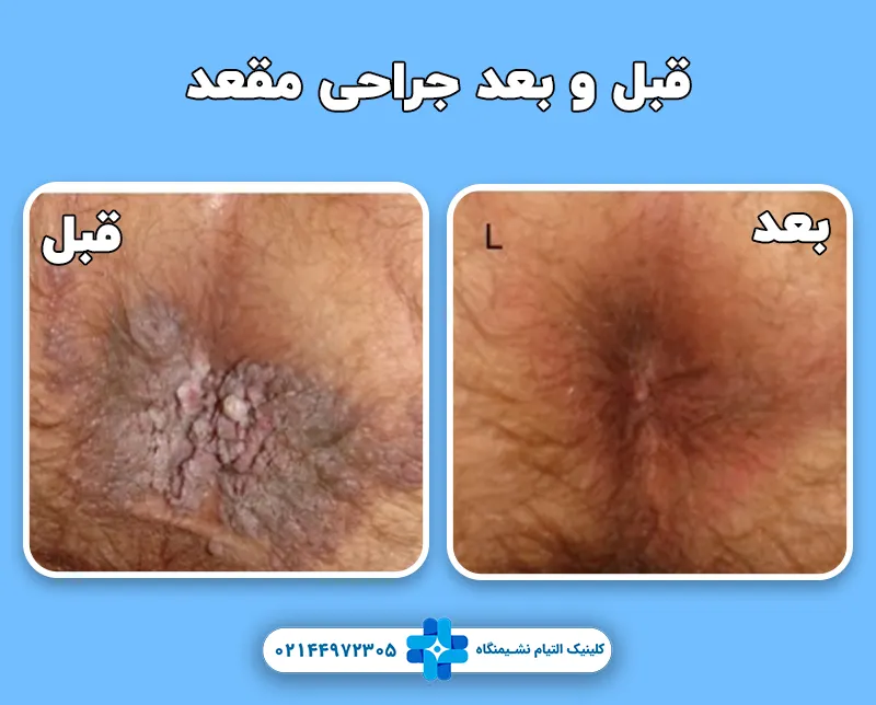 جراحی زیبایی مقعد