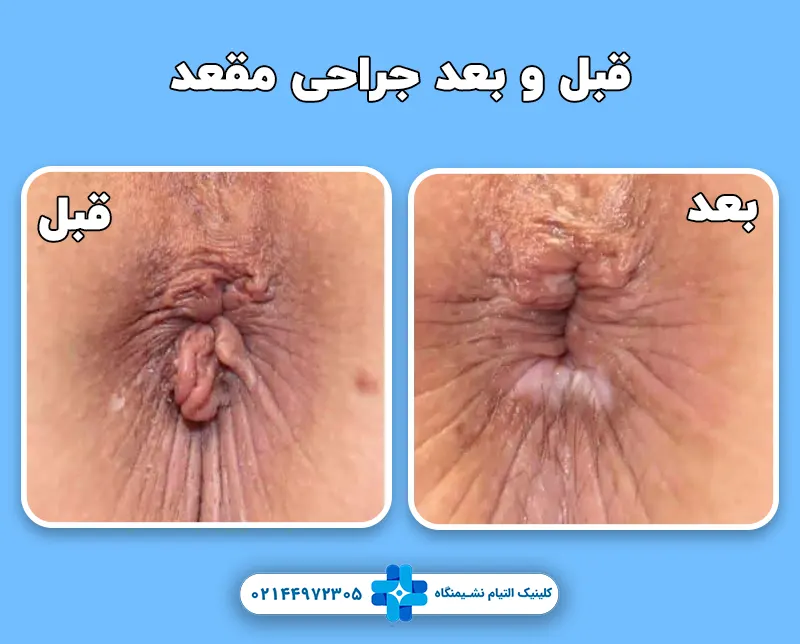 جراحی زیبایی مقعد