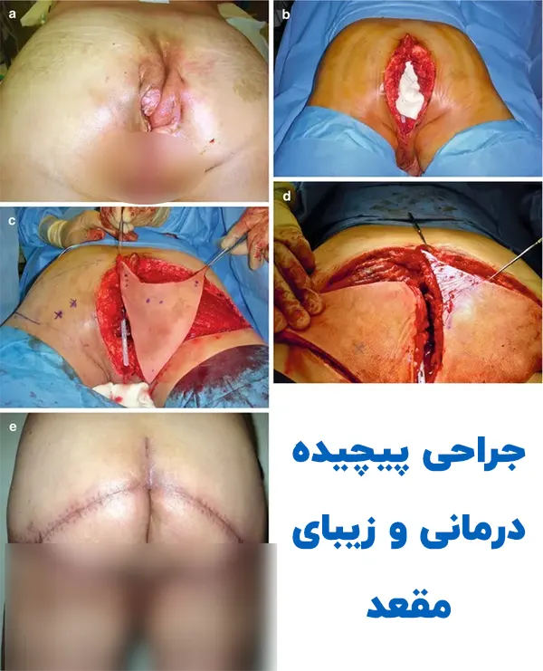 جراحی زیبایی مقعد