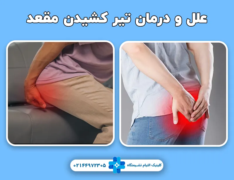 تیر کشیدن مقعد و درمان آن