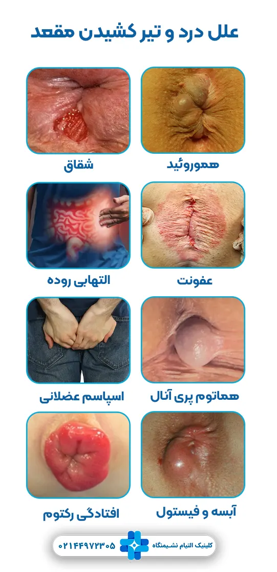 علل درد و تیر کشیدن مقعد