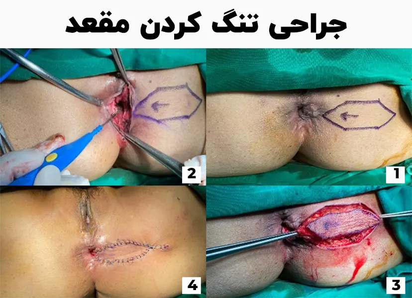 جراحی تنگ کردن مقعد