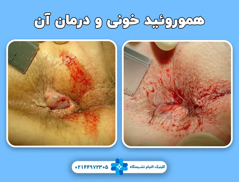هموروئید خونی و درمان آن