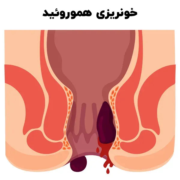 خونریزی هموروئید