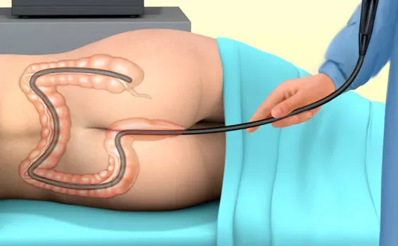 کولونوسکوپی