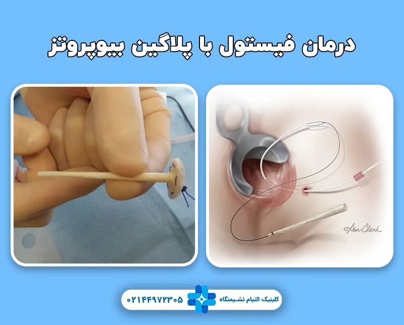 جراحی فیستول با پلاگین بیوپروتز