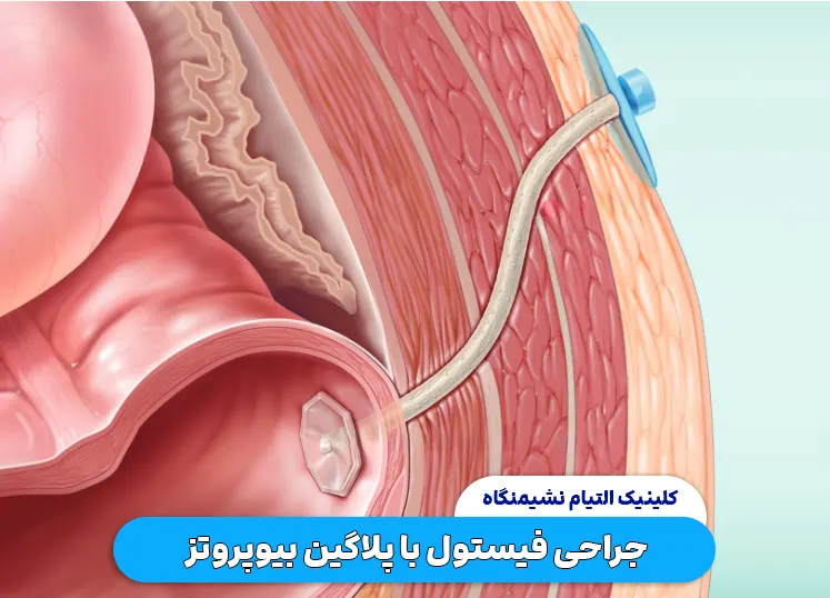 جراحی فیستول با پلاگین بیوپروتز