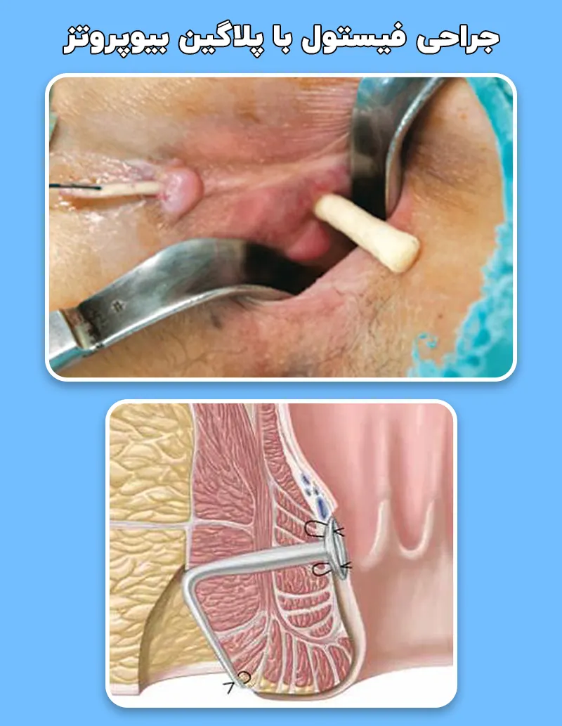 جراحی فیستول با پلاگین بیوپروتز