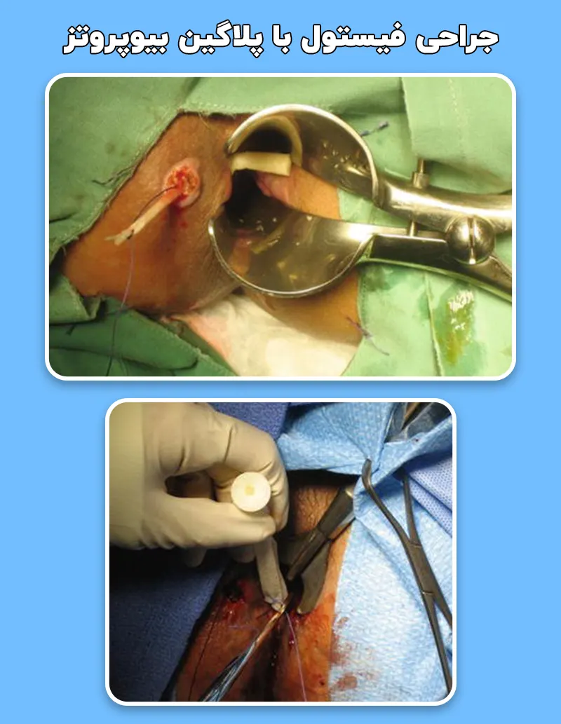 عمل فیستول با پلاگین بیوپروتز