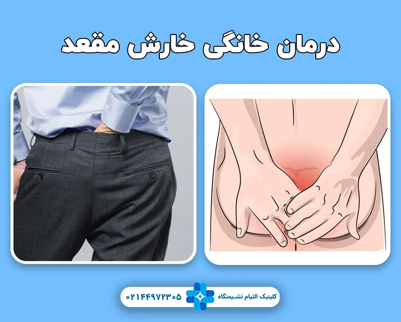 درمان خانگی خارش مقعد