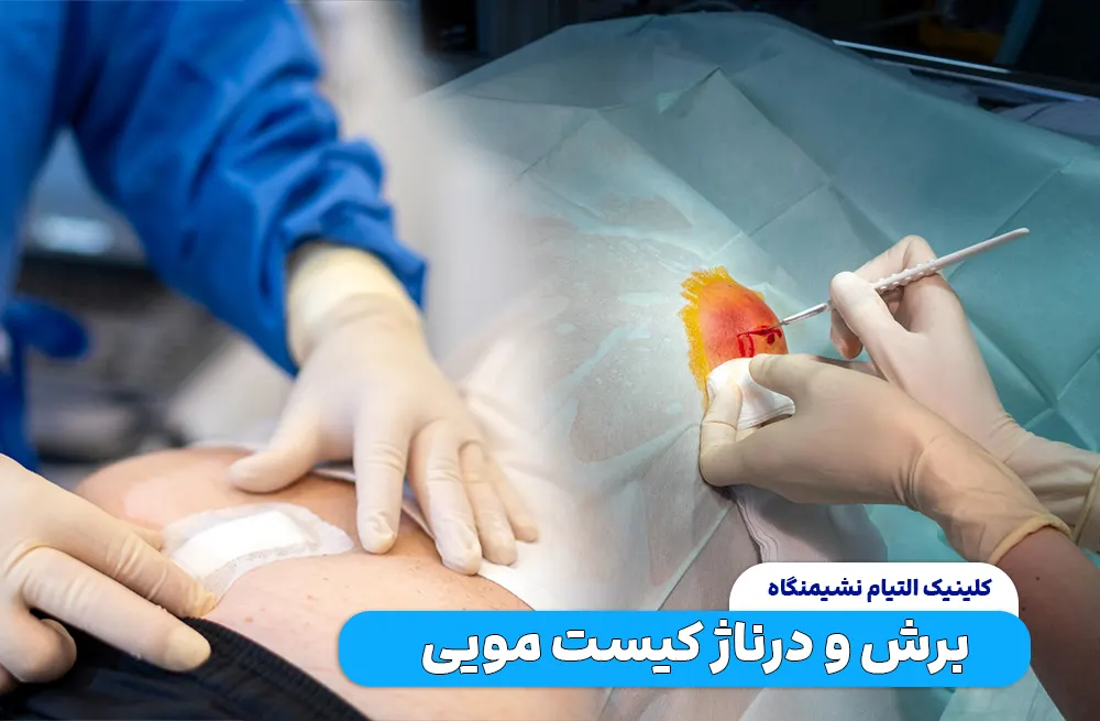 برش و درناژ کیست مویی