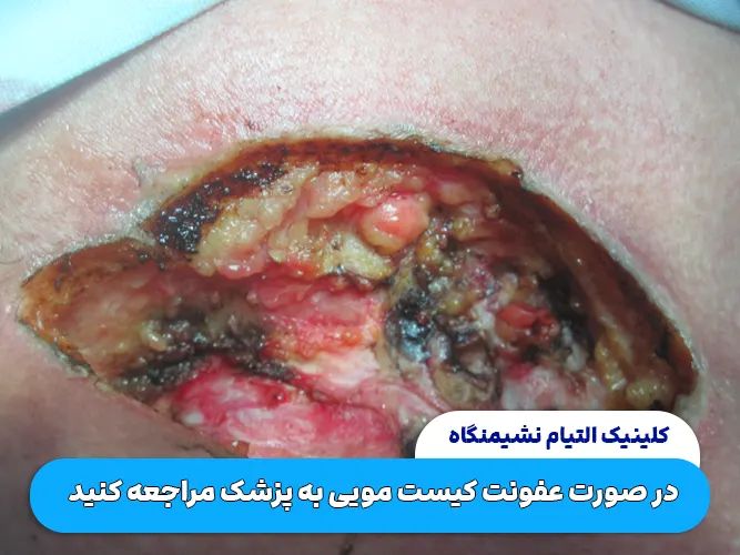 عفونت زخم کیست مویی