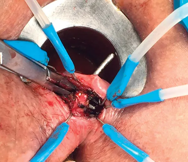 جراحی فیستول به روش لیفت lift