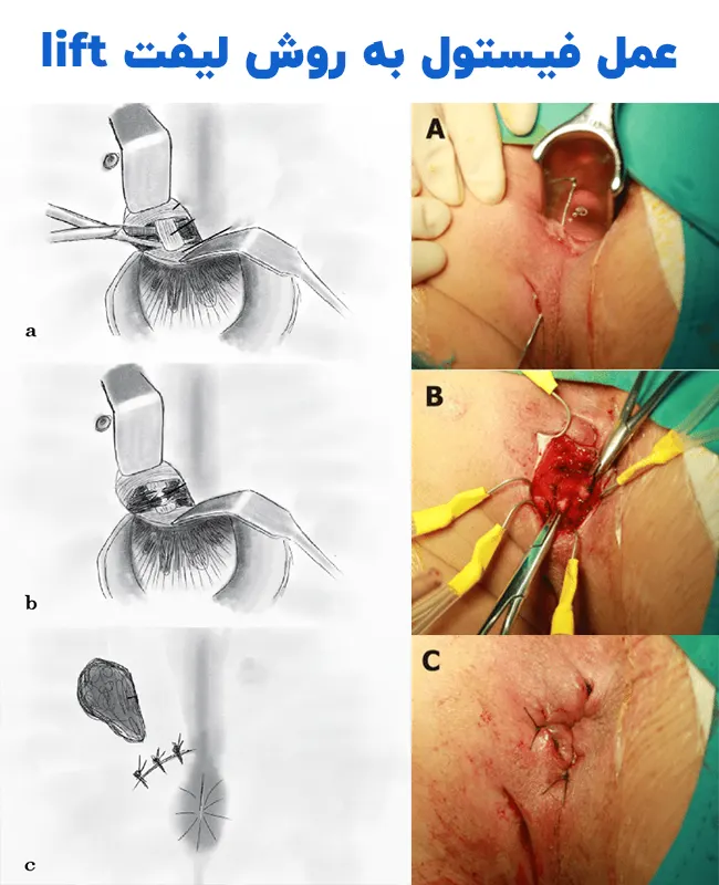عمل فیستول به روش لیفت lift
