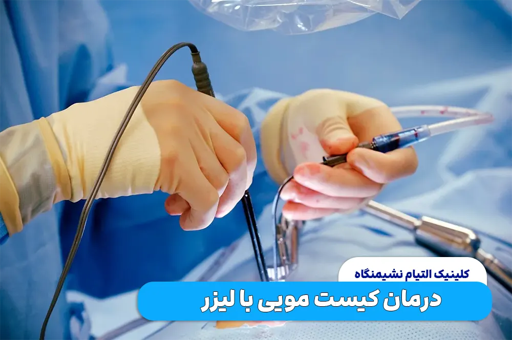 لیزر کیست مویی