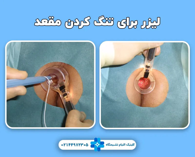 لیزر برای تنگ کردن مقعد