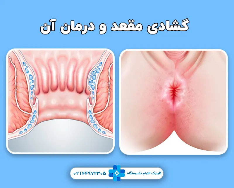 گشاد شدن مقعد