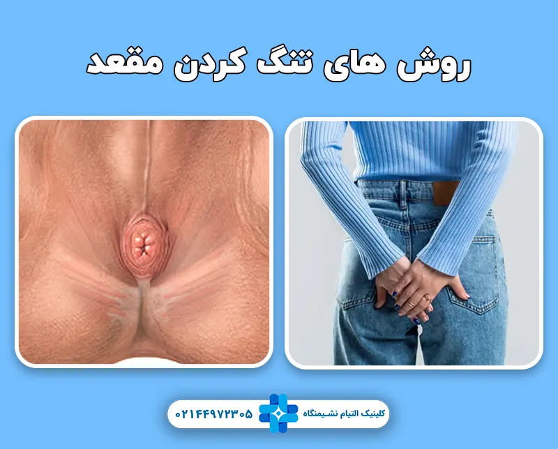 روش های تنگ کردن مقعد