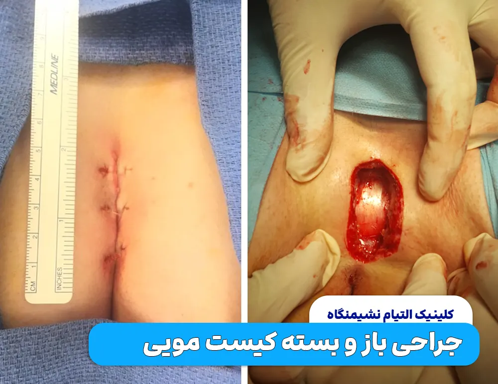 جراحی کیست مویی به روش باز یا بسته