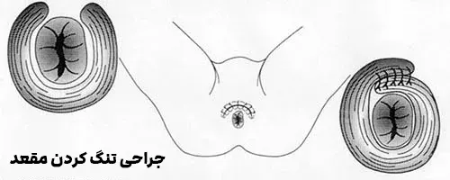 جراحی تنگ کردن مقعد