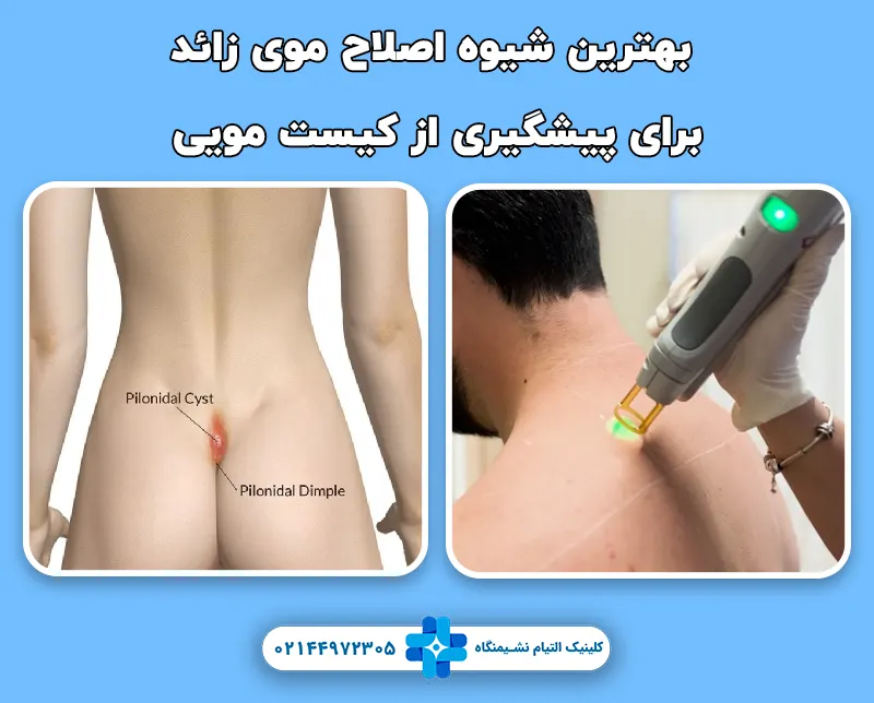 بهترین شیوه اصلاح موی زائد برای پیشگیری از کیست مویی