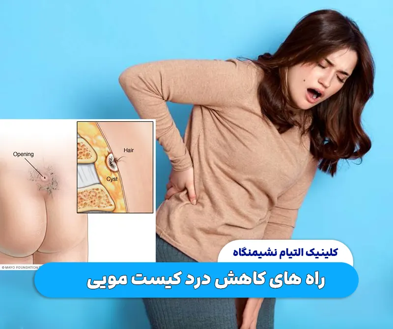 راه های کاهش درد کیست مویی