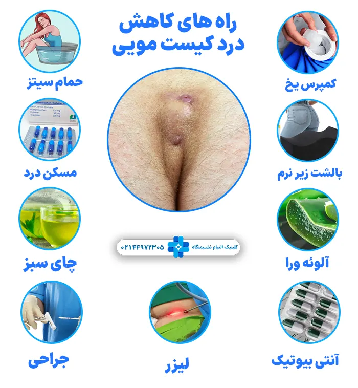 راه های کاهش درد کیست مویی