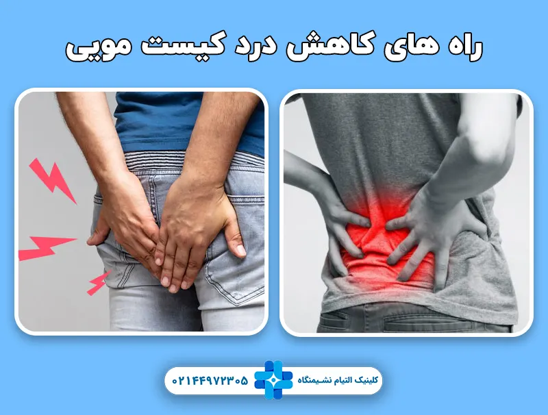 راه های کاهش درد کیست مویی