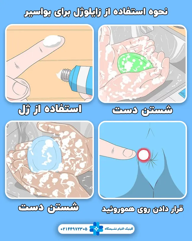 نحوه استفاده از زایلوژل برای بواسیر