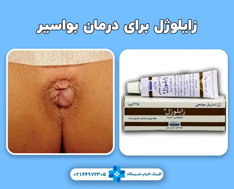 زایلوژل برای درمان هموروئید