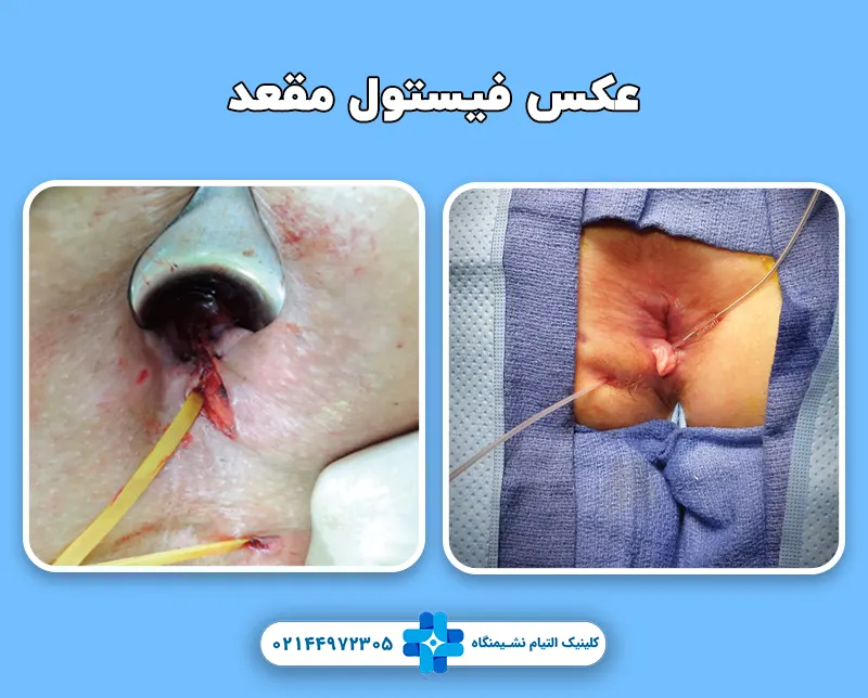 عکس فیستول