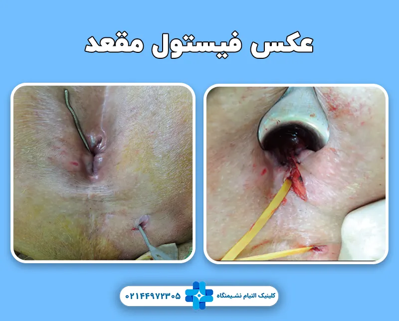 عکس فیستول مقعد