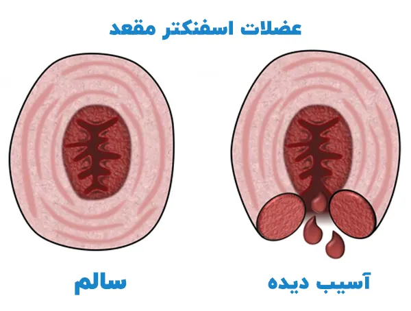 عضلات اسفنکتر مقعد