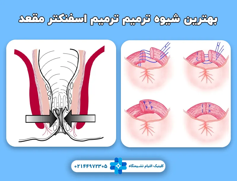 بهترین شیوه ترمیم عضلات اسفنکتر مقعد