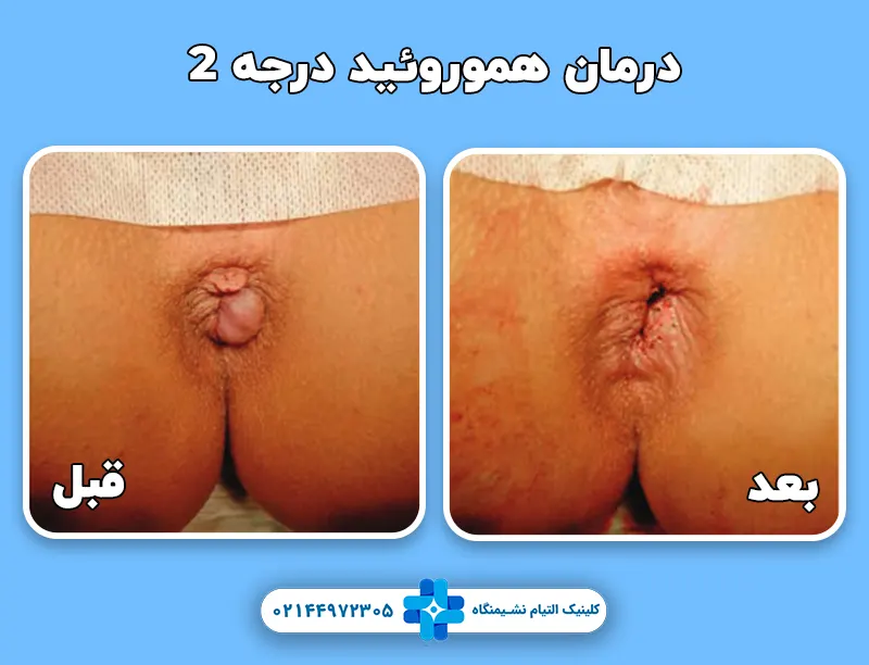قبل و بعد درمان هموروئید