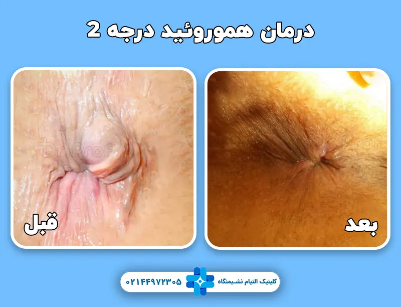 قبل و بعد درمان هموروئید