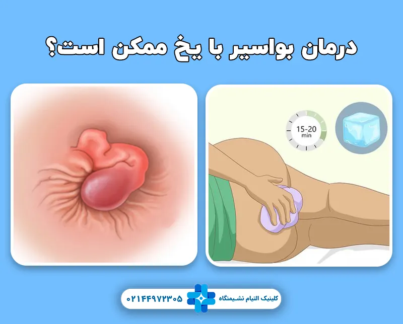 درمان بواسیر با یخ
