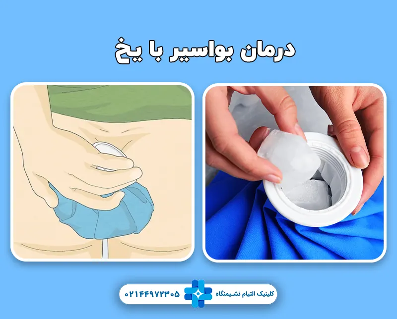 درمان بواسیر با یخ