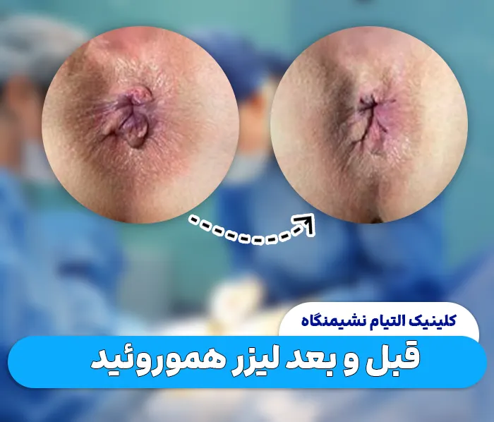 قبل و بعد درمان هموروئید با لیزر