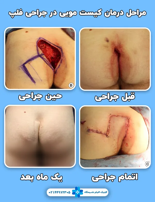 جراحی کیست مویی به روش فلپ