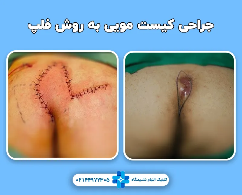 جراحی کیست مویی به روش فلپ