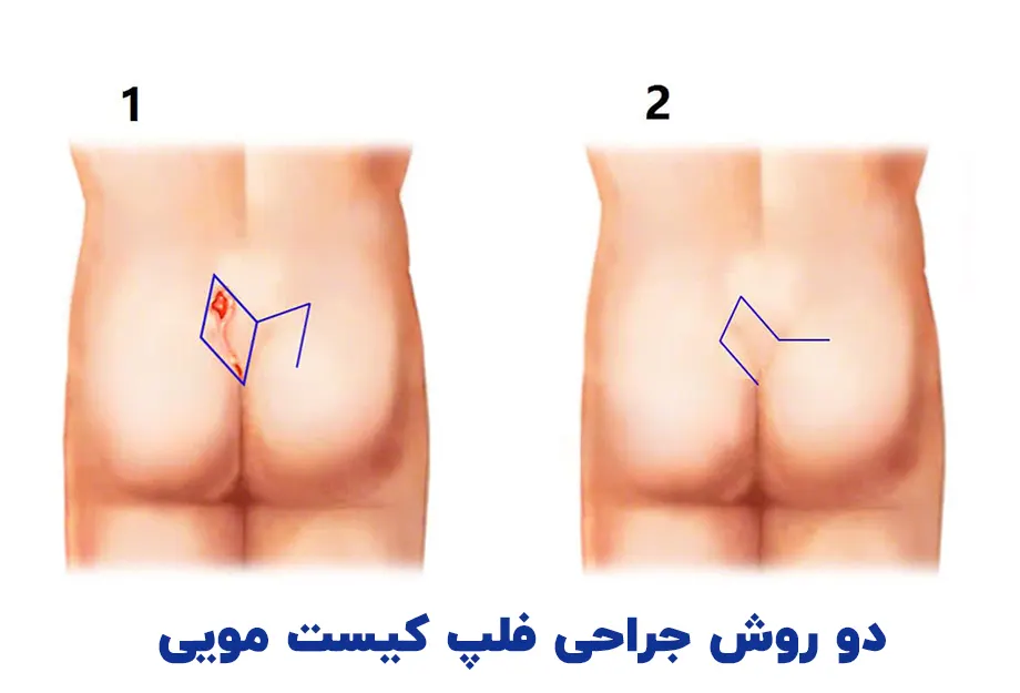 روش های جراحی فلپ کیست مویی