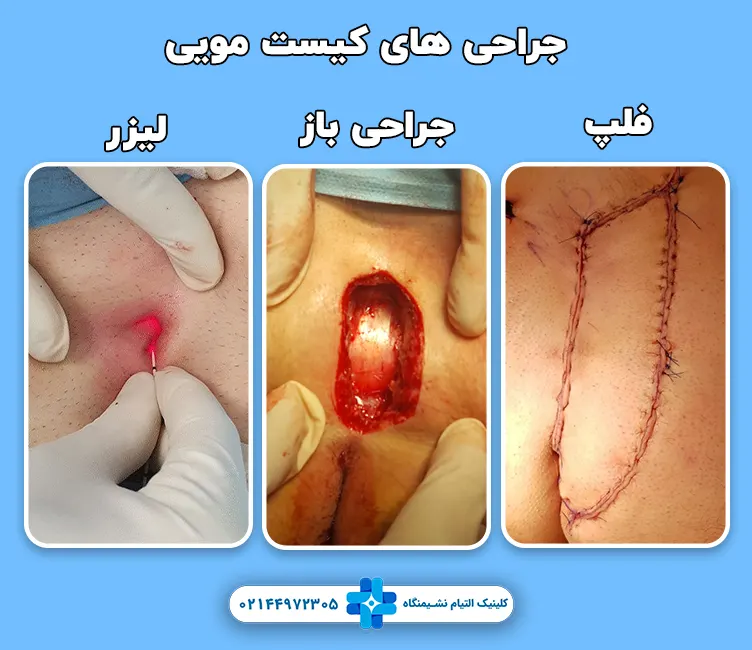 مقایسه جراحی کیست مویی فلپ، لیزر co2 و جراحی باز