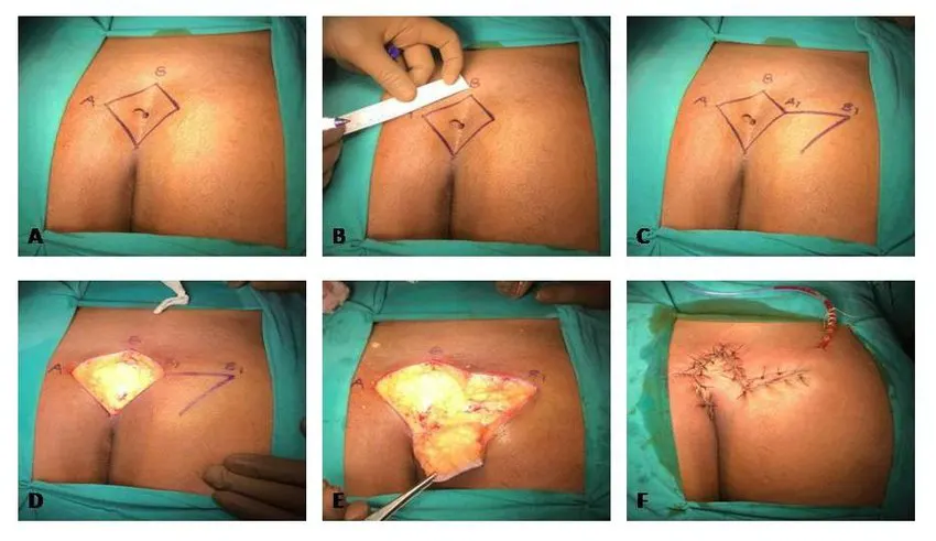 جراحی کیست مویی به روش فلپ