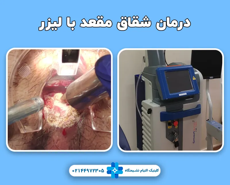 درمان شقاق با لیزر
