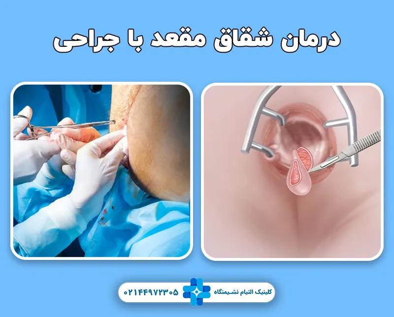 جراحی شقاق مقعد