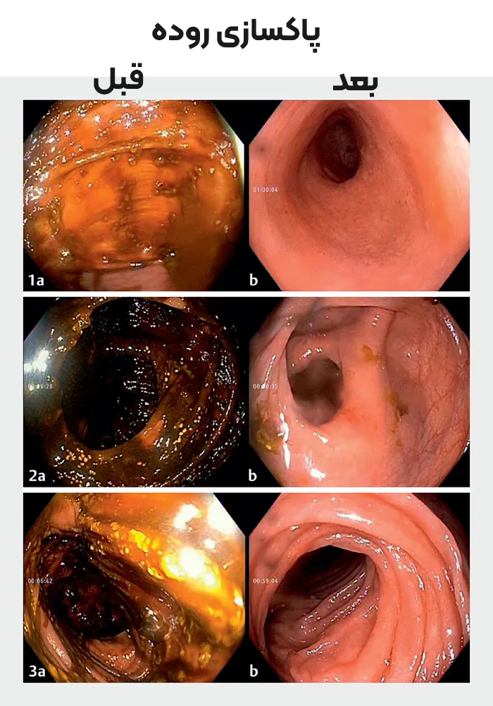 قبل و بعد پاکسازی روده