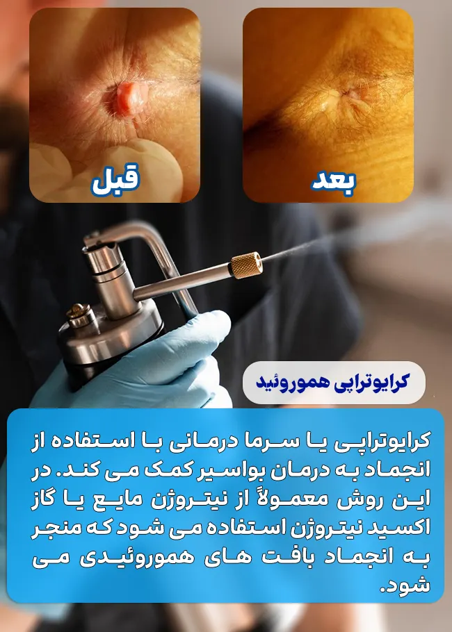 کرایوتراپی برای درمان هموروئید